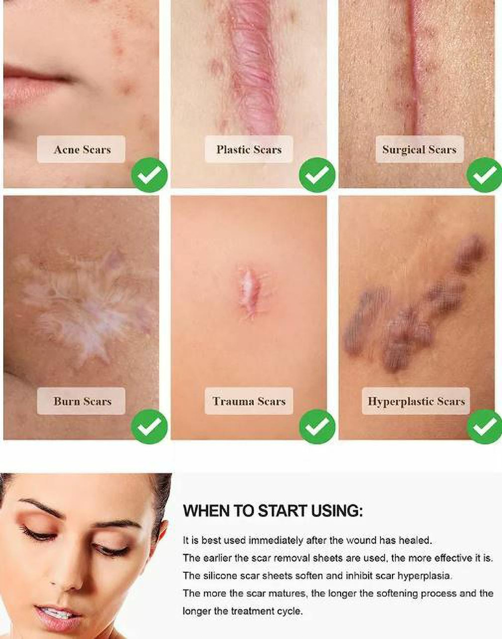 Silicone gel sheets outlet for acne scars