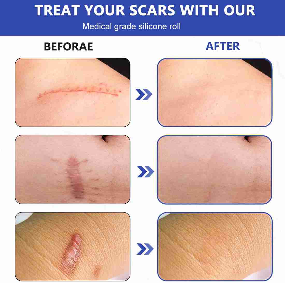 Silicone gel sheet for keloid scar deals
