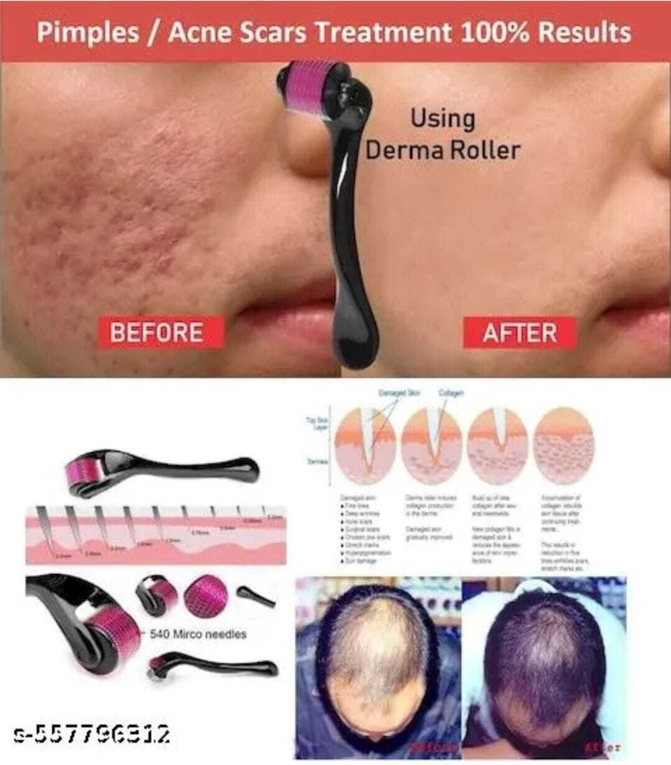 Image of Morbee Premium Derma Roller 0.5mm 540 Micro Needles For Hair Growth.10 (2 g)