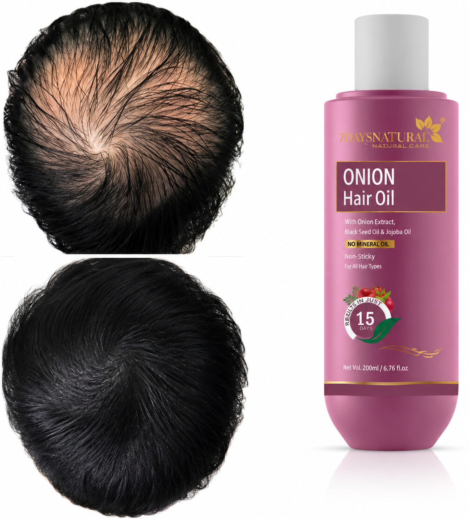 7days natural Onion Oil for Hair Regrowth | Anti Hair Fall | Dandruff | smooth shine hairs Hair Oil