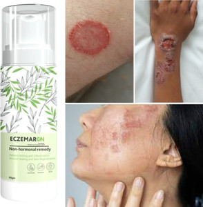 Eczemaron Ringworm Ayurvedic ItchCoat Anti fungal Malam for Ringworm, itching, Eczema cream (fungal remove cream