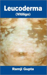 Leucoderma Vitiligo 01 Edition