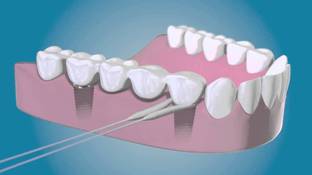 TePe Bridge and Implant Floss - 5 Pack