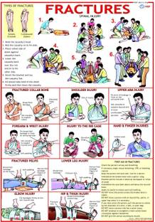 First Aid chart - Fractures Photographic Paper