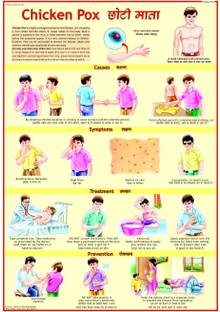 Chicken Pox Chart Photographic Paper