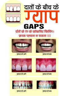 Poster Dental Doctor Gaps In Teeth (Hindi Poster) Large Poster (36 X 24 Inch, Multicolour) Fine Art Print