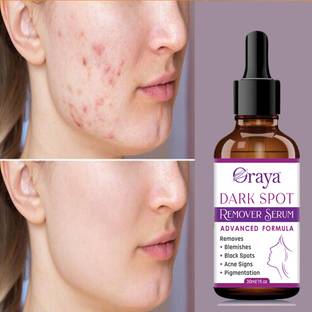 Oraya Dark Spot Remover Serum, Pimple Marks, Acne Scar, Pigmentation & Blemish-