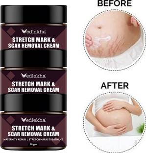 Vedlekha Stretch Marks Cream | Reduces Marks & Scars Removal Whitening Cream -50gm-3-Jar- Men & Women