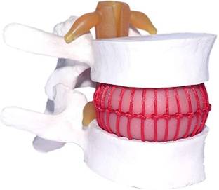 Max Plus | Vertebral Prolapse Simulator Model | Herniated Disc Model | For Demonstration Use | Anatomically Accurate | Anatomical Body Model