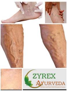ZYREX Varicose Veins Cure Tablets-180 Tablets Pack.