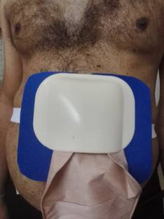 FLOVEIN STOMA GUARD FOR COLOSTOMY Bandage Protector