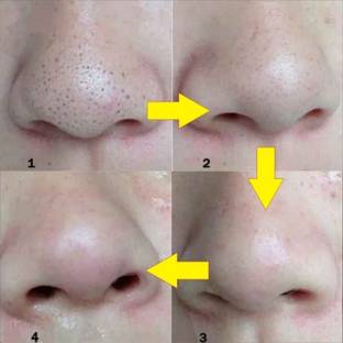 Emijun Deep Cleansing Pore Strips, Nose Strips for Blackhead Removal ( 10Strips)