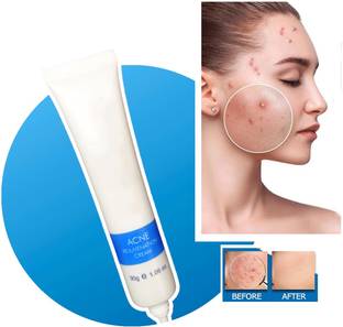 tanvi27 Remove Pimple Spot Oil Control Shrink Pores Tight Moisturizer Smooth Skin Care