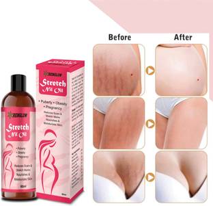 RENGLOW Stretch Nil Oil - for Scar And Stretch Mark Reduction After Pregnancy,Puberty