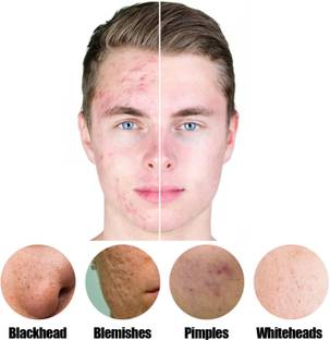 ADJD Skin Care Face Whitening Cream Moisturizing Oil Control Acne Remover