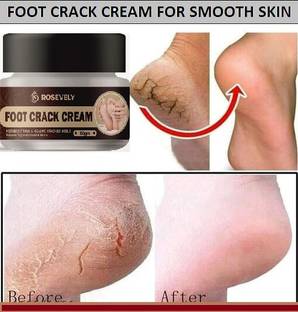 Rosevely feet crack heel repair cream Smooth Foot Crack Cracked Heel Repair Foot Cream