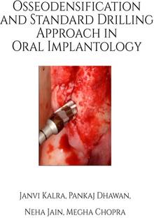 Osseodensification and Standard Drilling Approach in Oral Implantology