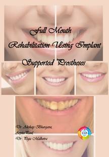 Full Mouth Rehabilitation Using Implant Supported Prostheses