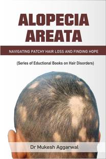 Alopecia Areata