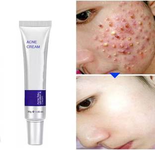 EVERERIN Acne Pimple Scar Cream, Anti-inflammatory | Acne, Pimples, Whiteheads And Blackheads Removing Cream