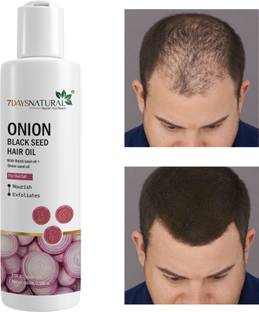 7days natural Onion Oil for Hair Regrowth | Anti Hair Fall | Dandruff | smooth shine hairs Hair Oil