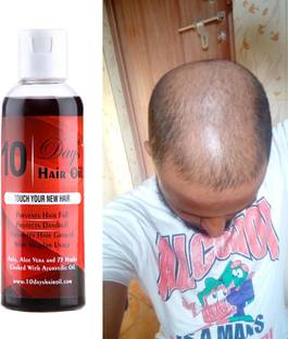 7 Days 10 Days hair regrowth hair fall control Hair Oil