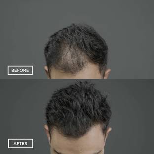 imelda Hair Building Fibers Black For Men ANd Women KSSEP25 Extreme Hair Volumizer Hair Fiber