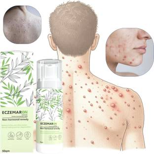 Eczemaron Ringworm Anti Fungal Cream For Men & Women.