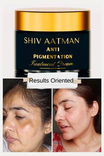 Shiv Aatman Anti pigmentation cream for Melasma, Hyperpigmentation, Severe Old Dark Spots