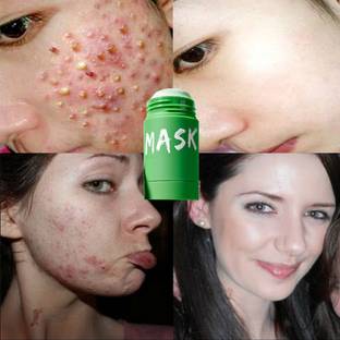 Latixmat Anti Acne Purifying Oil Control Stick Mask for Glowing & Pimple Free Skin