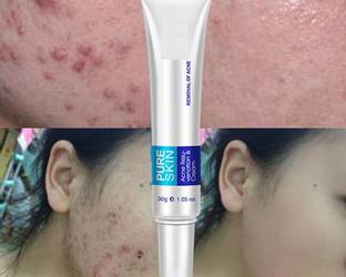 YAWI ACNE Removal Cream Gel Anti-Acne Scar Treatment Skin Care Face