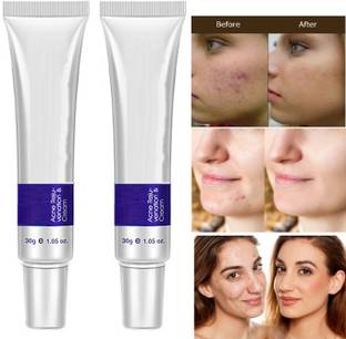 HUZURLU Face Skin Care Acne Treatment Removal Cream Spots Scar