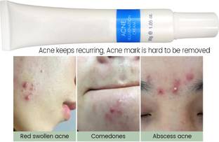 tanvi27 Face Skin Care Acne Treatment Removal Scar Blemish Marks Cream