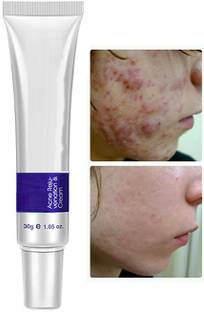 HUZURLU Night Cream For Acne Remover Age Spots And clean open pores .