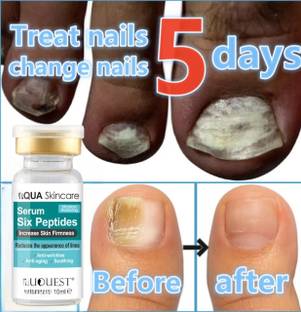 Adi Express Ingrown Toenail Treatments Nail Repair Essence Made with Ginger clear