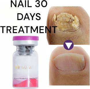 Adi Express nail fungus treatment,toenail corrector 30 DAYS broken nail repair gel yellow