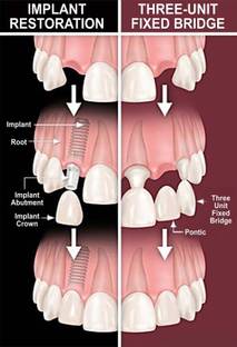 Poster Dental Dentist Doctor Implant Restoration Three Unit Fixed Wall Poster (300 Gsm Matte Paper, 13 X 19 Inch, Multicolour) Fine Art Print