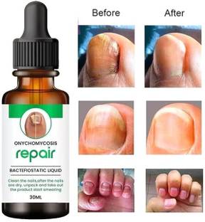 Berry Bliss Onychomycosis Nail growth & strong serum,AntiInfective,Fungal Infection Removal