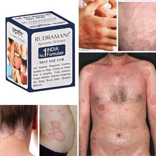 Rudramani Anti fungal Malam - for Ringworm, itching, Eczema .Skin Infection, Skin Recovery