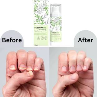 Eczemaron Ringworm Nail Growth and Shine Recovery Cream