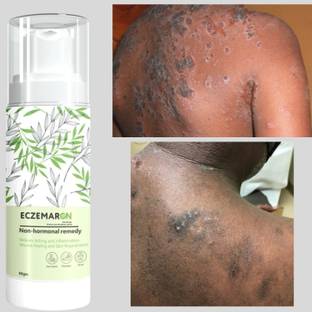 Eczemaron Ringworm Anti Fungal Cream with brightening skin For Men & Women