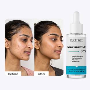 RoseBrite Acne Mark & Hyperpigmentation Serum – Corrects Dark Spots, Refines Skin Texture & Boosts Radiance