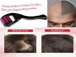 YLDZ Hair Growth Activator Derma Roller For Hair Growth 0.5 mm with 540 Titanium Needles