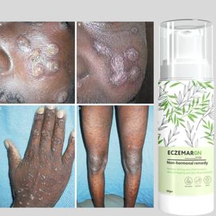Eczemaron Ringworm Itching Anti fungal cream - for Ringworm, itching, Eczema & Fungal Infection Best Fungal Cream