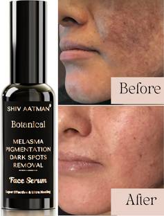 Shiv Aatman Melasma, Pigmentation, Dark Spots Removal Face Serum. 100% Natural. Excellent Skin Brightening & Lightening. Heals Sunburn, Tanning, Patchy Dark Skin. With Free Skin Brightening Natural Face Wash only on PREPAID ORDERS