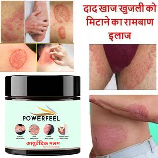 POWERFEEL Ayurvedic -Anti fungal Malam - for Ringworm, Eczema & Fungal Infection