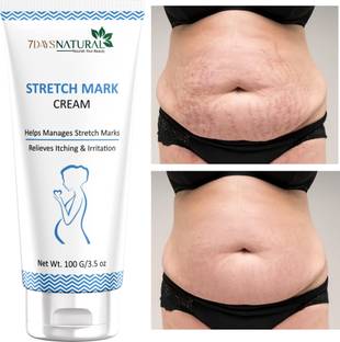 7days natural Stretch Marks Removal Cream for Women Men 100% Natural Ayurvedic Cream Intimate Cream