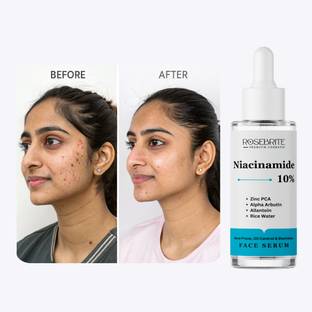 RoseBrite Breakout-Control Serum – Niacinamide & Zinc PCA Clear Skin, Soothe Redness, Tighten Pores & Control Oil Daily