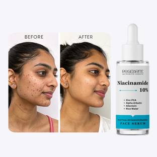 RoseBrite Advanced Blemish Serum – Niacinamide 10% + Zinc PCA Work Together to Control Acne, Clear Skin & Strengthen Barrier