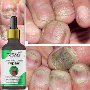 Newsio Advanced Nail Fungus Treatment Repair Foot Removal Toe Fungal Infection Liquid for nails